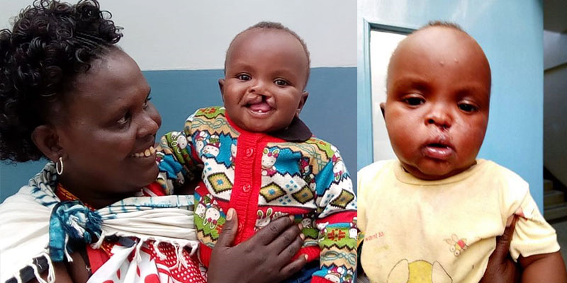 Isaac received cleft lip surgery supported by Smile Train