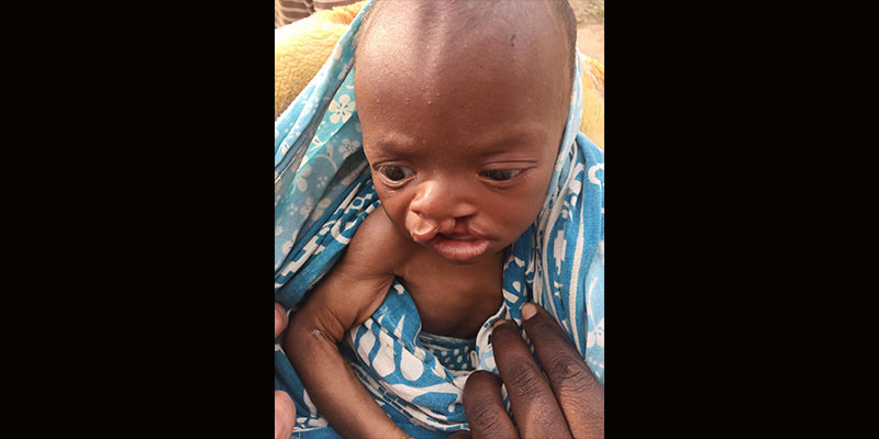 Baby Issac with a cleft lip in Kenya